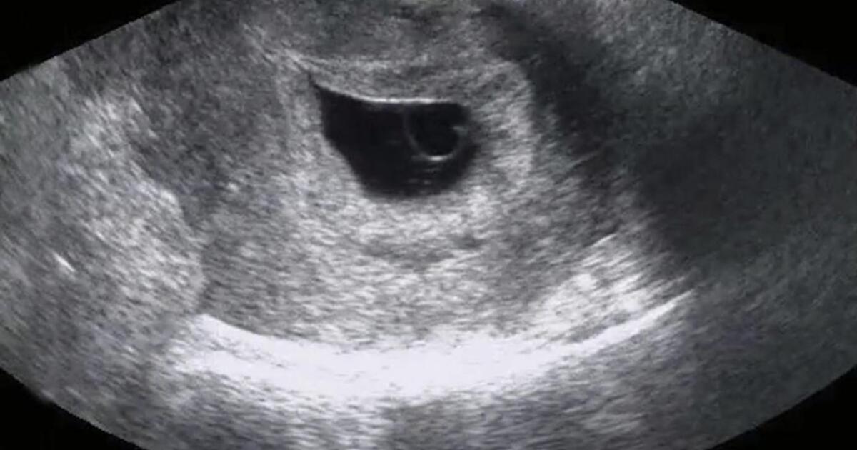 6 эмбриональная неделя. Снимок УЗИ на 6 неделе беременности. Беременность 7 недель фото эмбриона на УЗИ. УЗИ беременности 6-7 недель плодное яйцо. УЗИ 6 недель беременности фото.