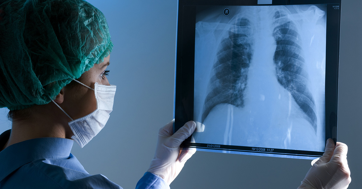 Каким людям нужно проходить обследование на рак лёгких: отвечает врач