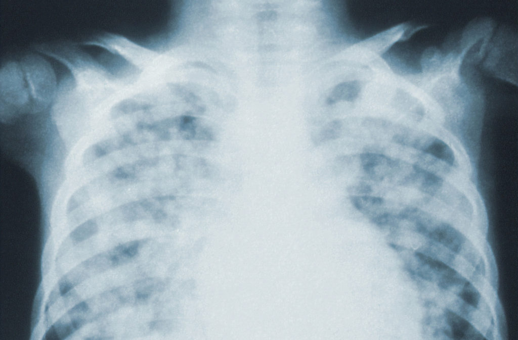 Искусственный интеллект научили предсказывать болезни сердца по рентгену