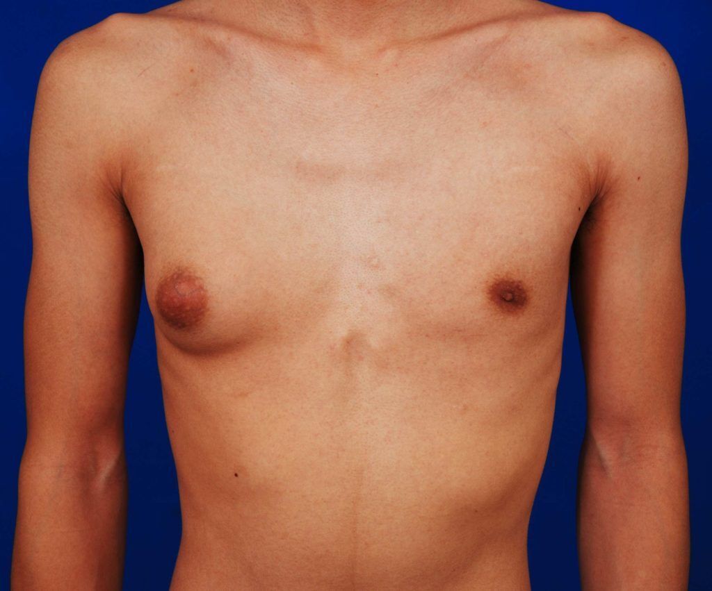 Почему у мужчин всё чаще начинает расти грудь