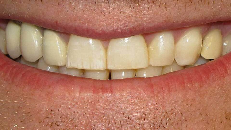 Стоматолог объяснил, почему желтеют зубы
