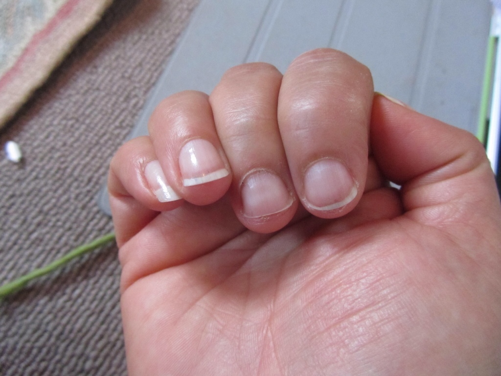 Какие болезни могут быть причиной некрасивых ногтей