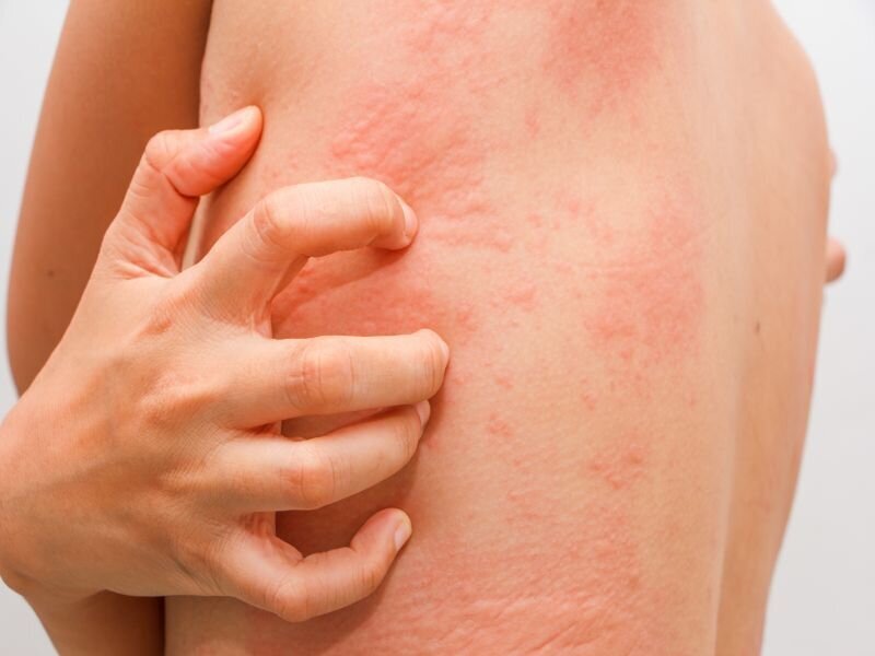 Аллергия и нервы - где связь?