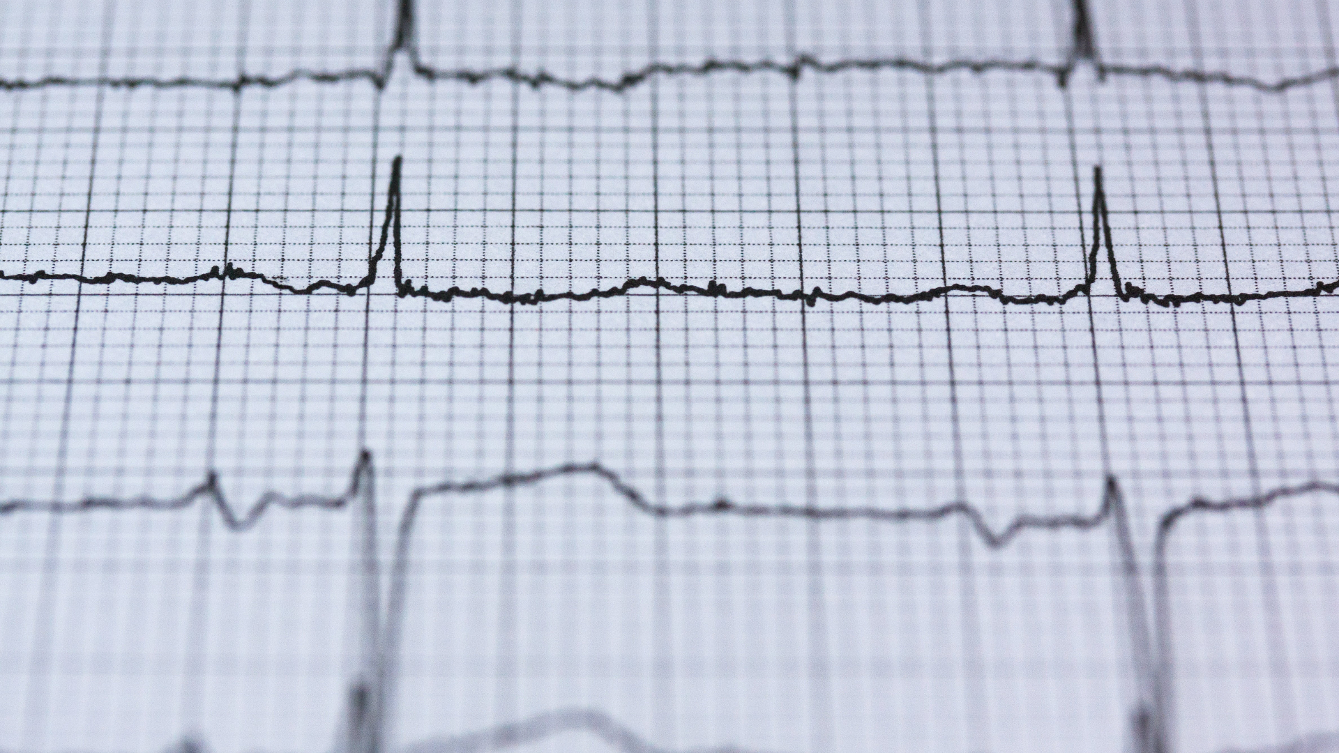 В России научились определять риск смерти сердечников по нескольким ЭКГ