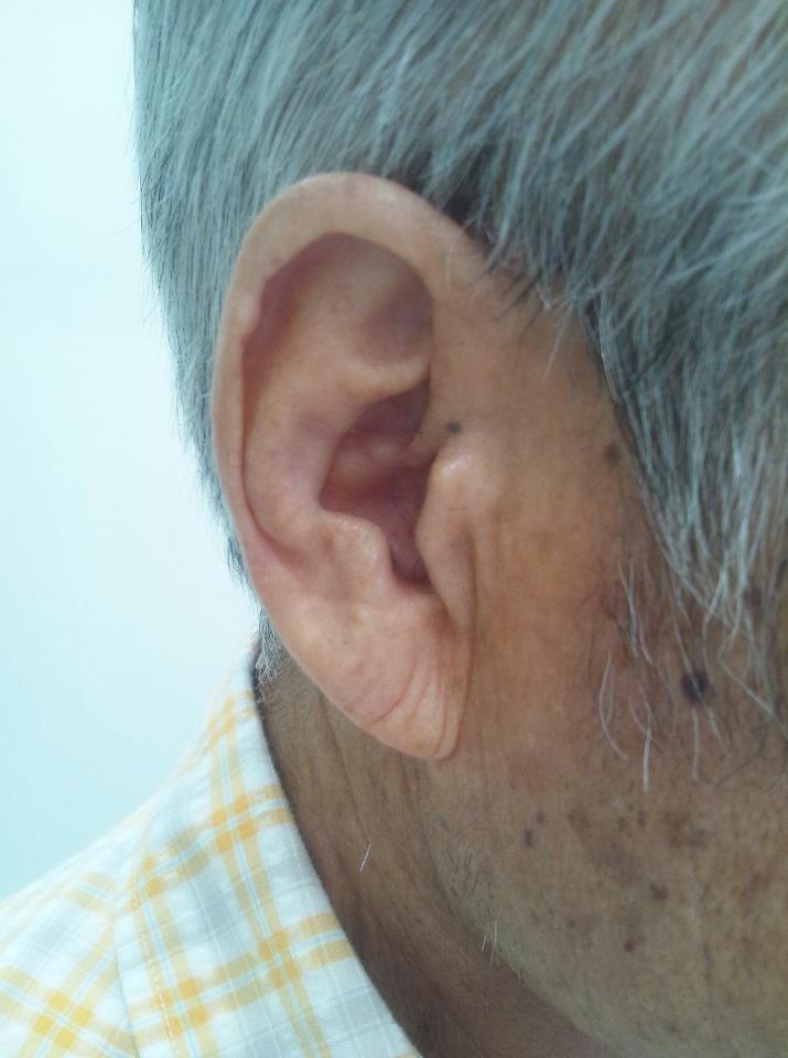Как внешний вид ушей может помочь для определения риска инфаркта