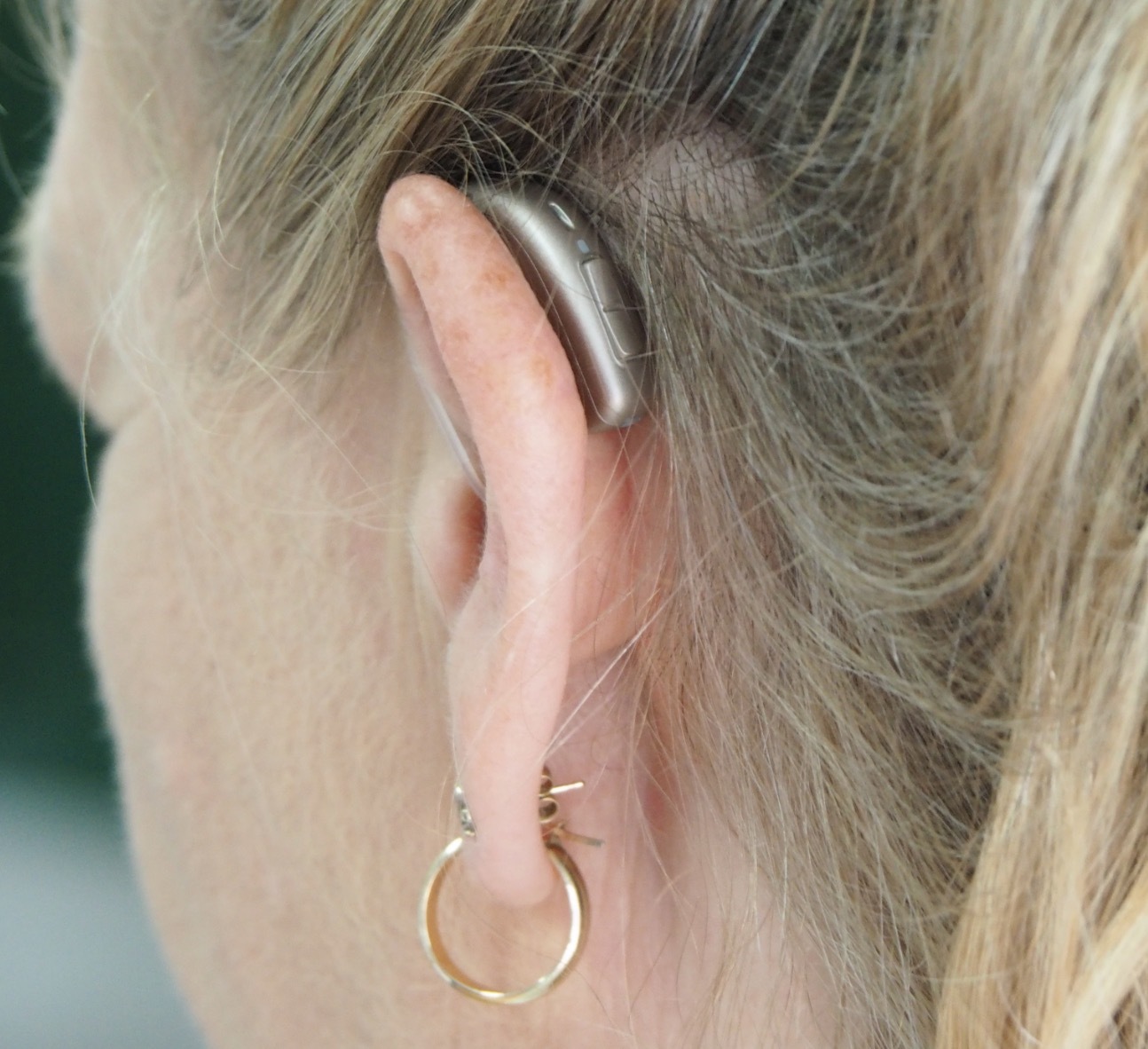 Слуховые аппараты снизили риск смерти у людей с потерей слуха