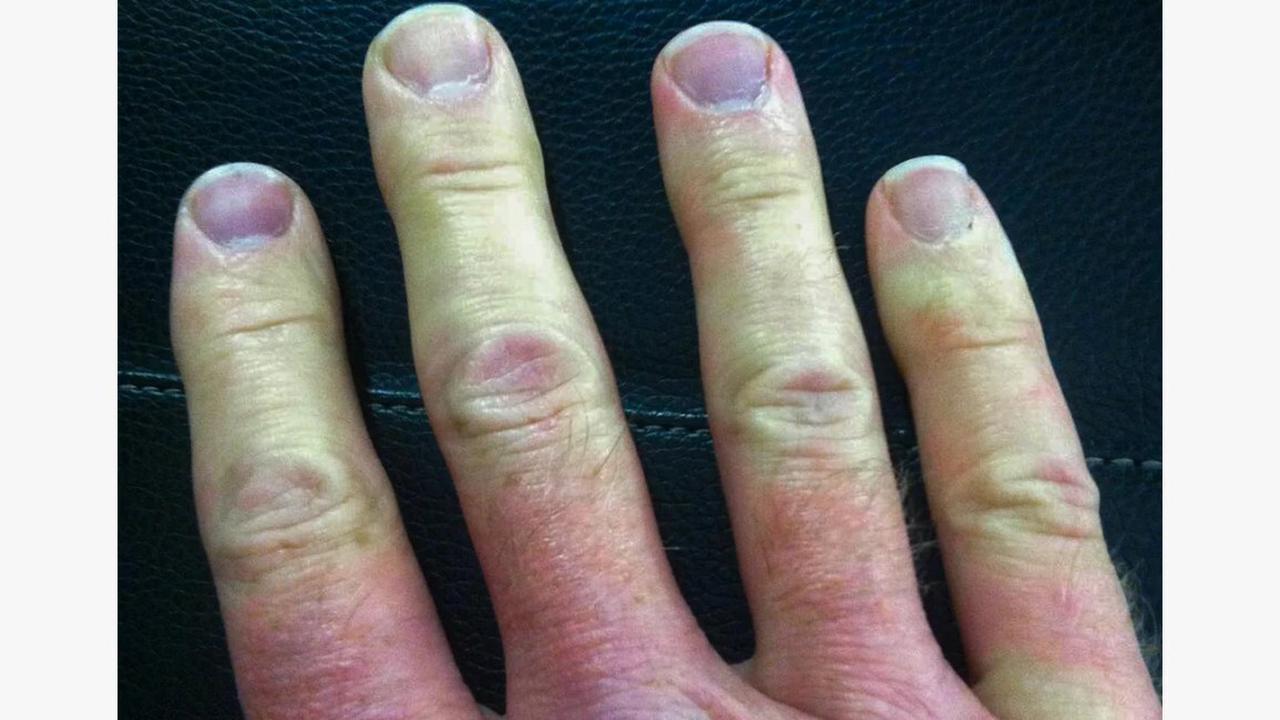 Причины почему пальцы на руках становятся холодными и как с этим бороться