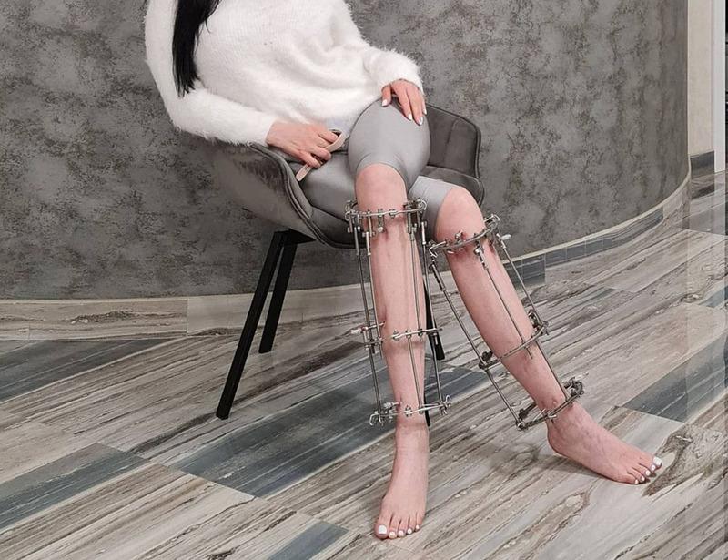 Как выглядит аппарат Илизарова