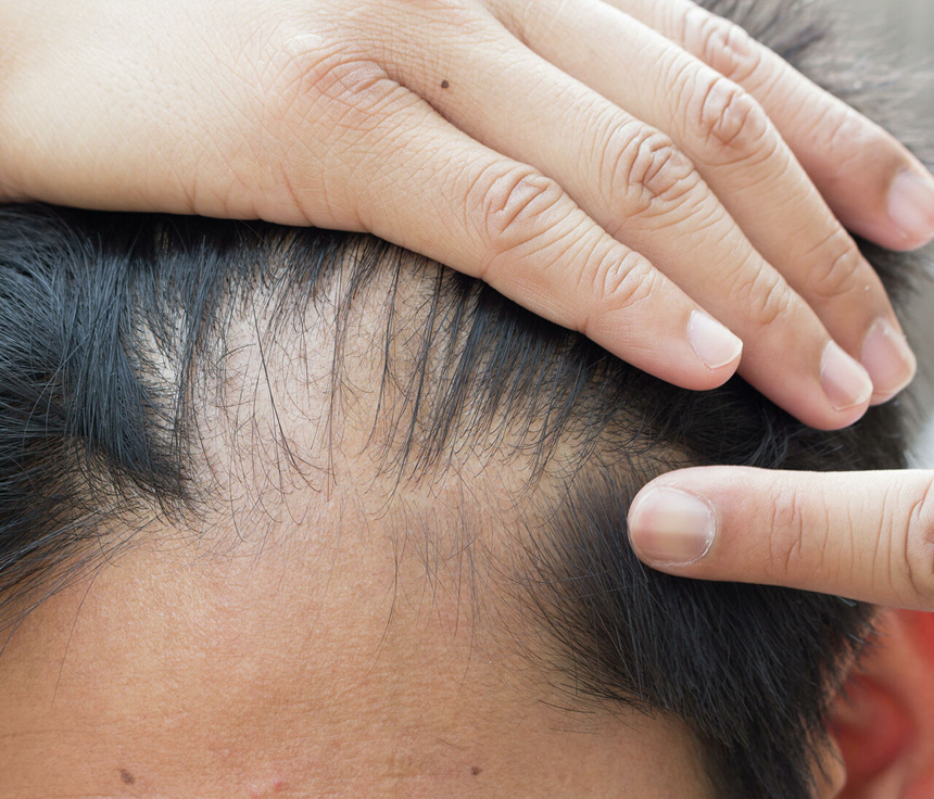 Врач раскрыл тайну восстановления волос и ногтей после коронавируса