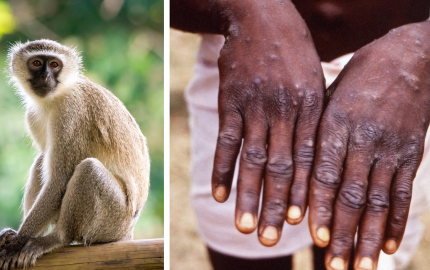 Появится ли в России обезьянья оспа