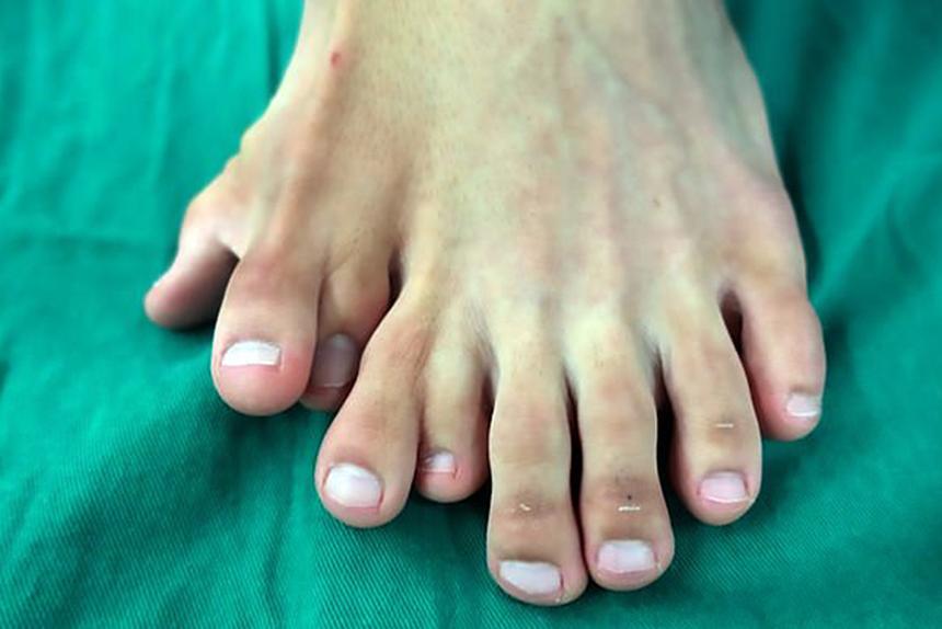 Учёные: за появление лишних пальцев и рак отвечает один и тот же ген