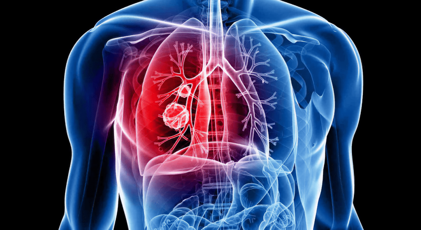 Учёные научились помечать раковые клетки для обнаружения их иммунитетом