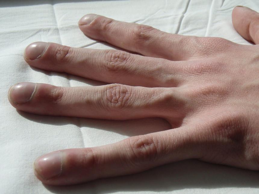 Лекарство от вызывающей "пальцы-сосиски" болезни эффективно против пневмонии