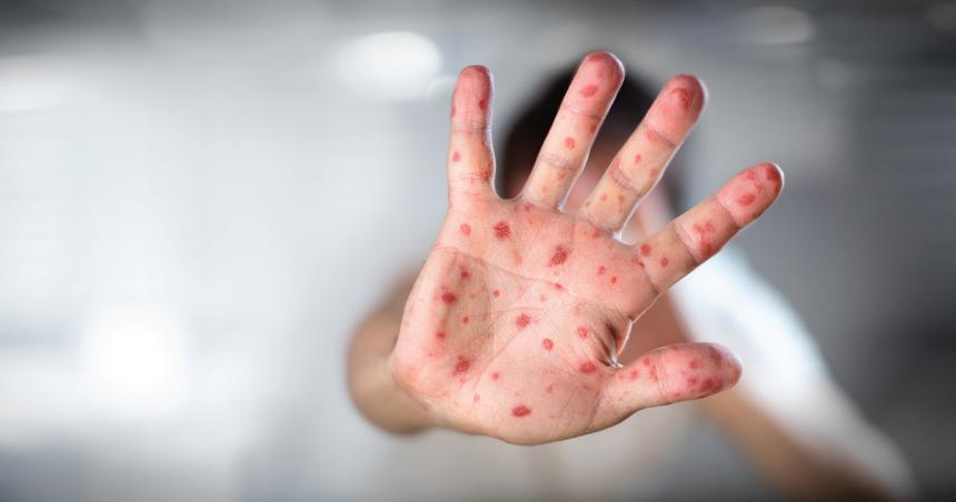 Корь — смертельно опасное заболевание. Как проверять себя без врачей