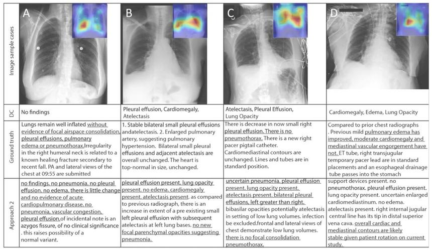 В первом ряду таблицы — рентгеновские снимки грудной клетки, во втором — диагноз врача коротко, в третьем — более развёрнутый комментарий врача, в четвёртом — описание, сгенерированное нейросетью. Подчёркнутые фрагменты демонстрируют, что версии искусственного интеллекта и врача в целом сходятся, хоть сам текст и нуждается в редактуре