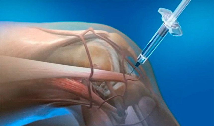 Популярный способ избавления от боли в суставах оказался разрушительным для них