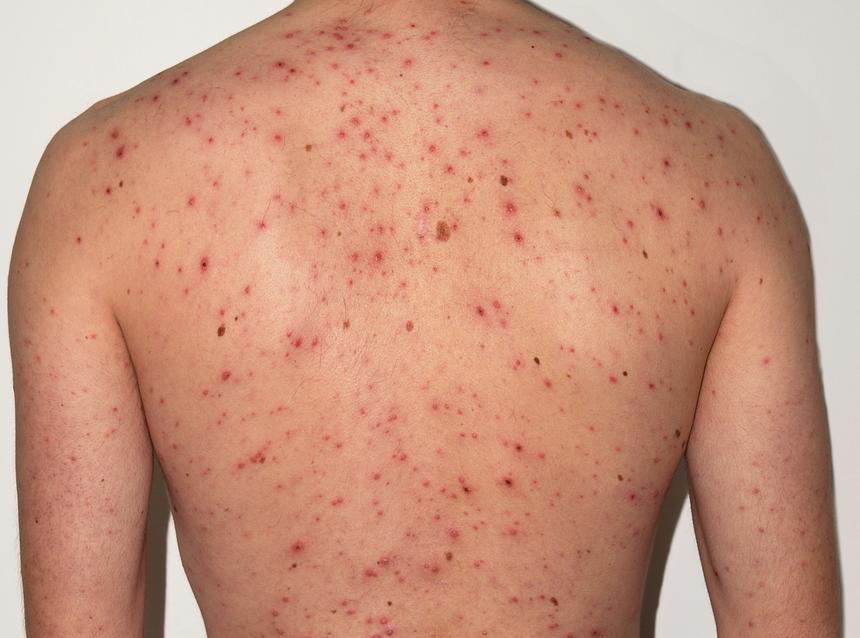 При каких условиях вы можете два раза за жизнь заболеть ветрянкой