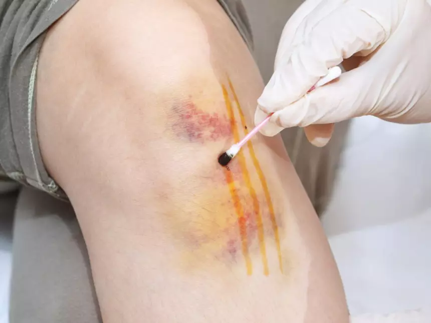 Российский врач развеяла один из самых главных мифов о йодной сетке