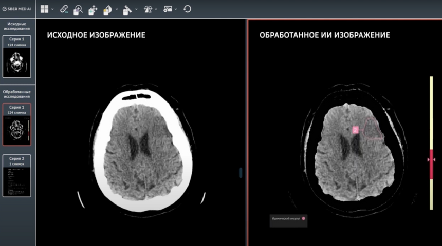Дочерняя компания Сбера создала сервис для лечения инсульта с помощью ИИ
