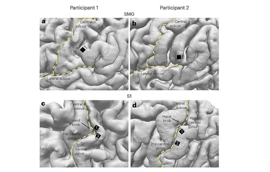 Компьютер прочитал «мысли» уже второго пациента