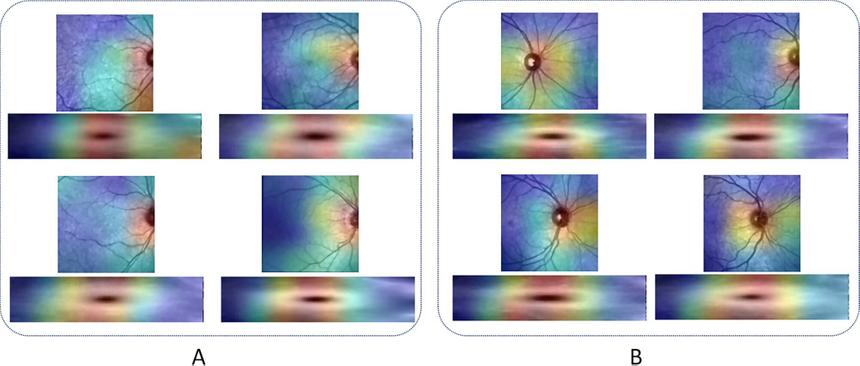 Разработан способ диагностики рассеянного склероза по снимкам глаз