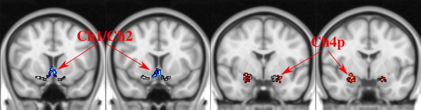 Ученые нашли способ повысить эффективность лекарств от болезни Альцгеймера
