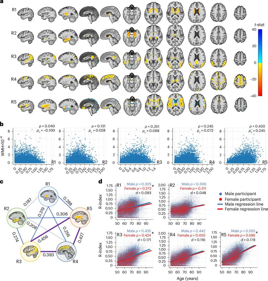 Ученые обнаружили новые закономерности старения мозга