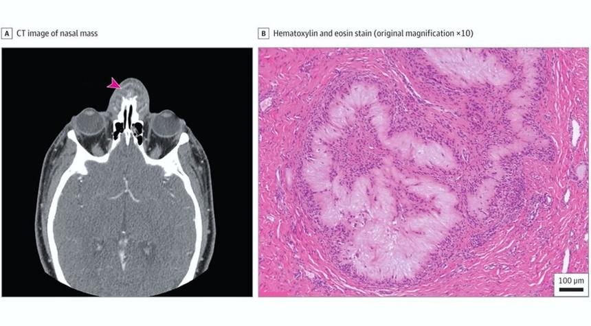 В США впервые в качестве симптома подагры выявили воспаление и боль в переносице