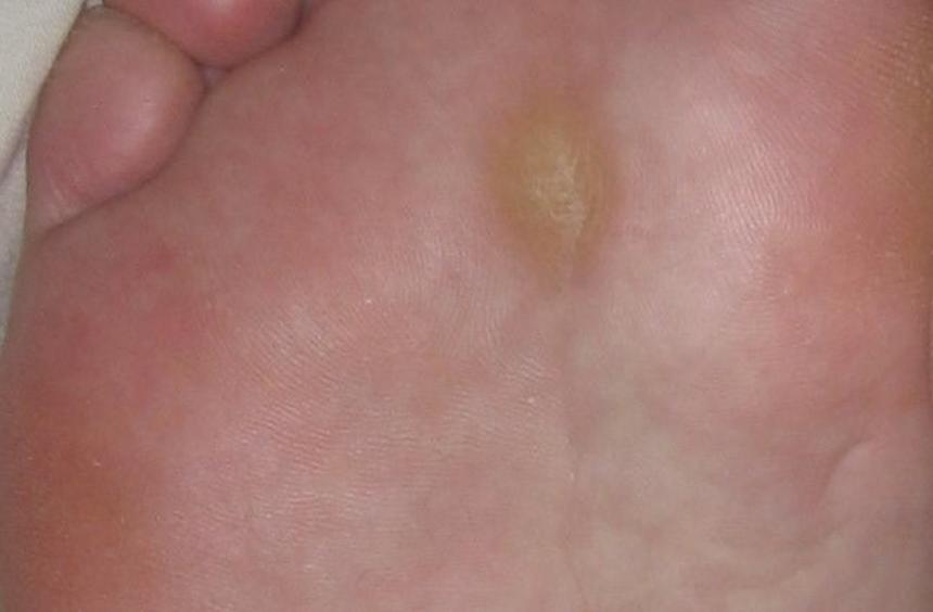 Врач предупредила, что мозоли могут стать источником опасной для здоровья инфекции