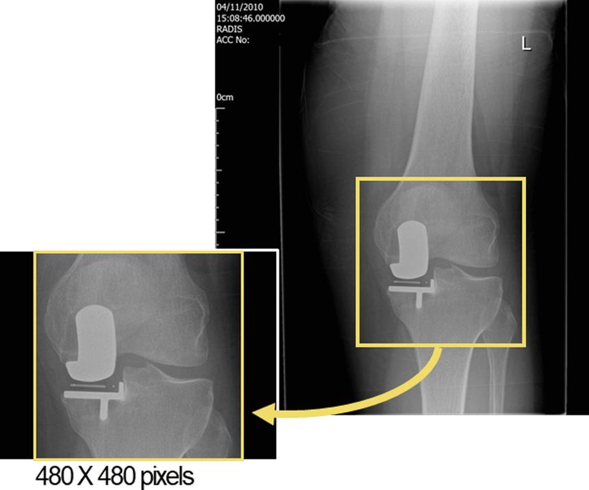 ИИ превзошел врачей в прогнозировании результатов операции на колене