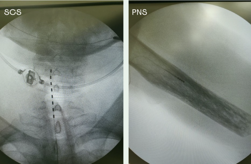 Рентгеновский снимок электродов, имплантированных одному из участников эксперимента.