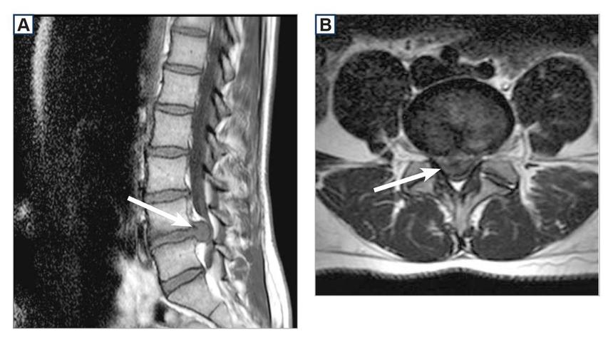 Вот так выглядит грыжа на снимке