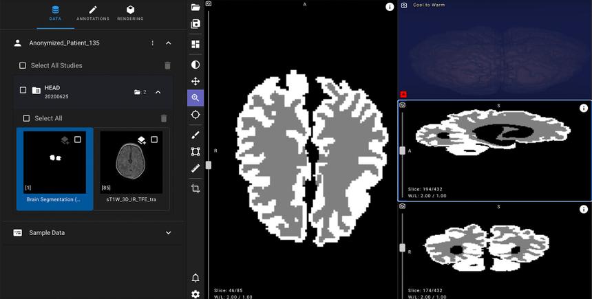 Яндекс создал нейросеть для ранней диагностики ДЦП у младенцев