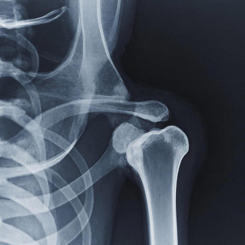 Учёные использовали жировую ткань для восстановления костей