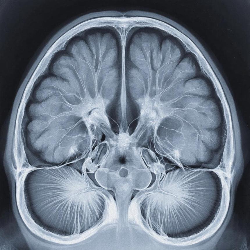 На Чукотке нейросети обучат расшифровывать КТ мозга