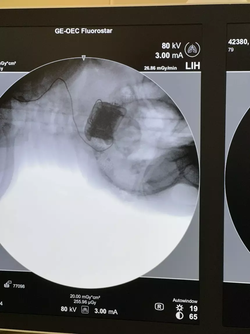 Микроамперы против слепоты в первом российском нейроимпланте ELVIS